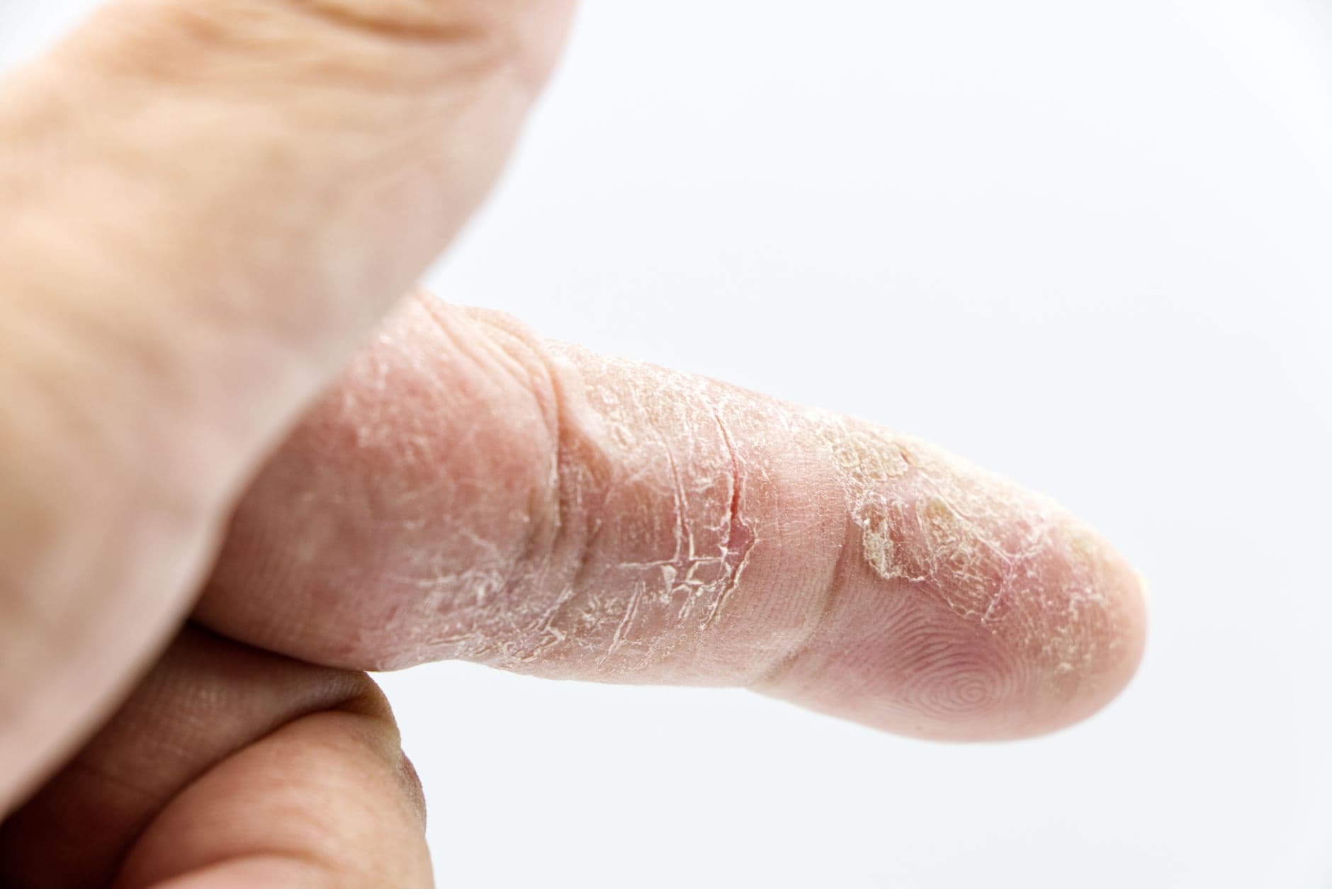 Adult Eczema in the PNW: Root-Cause Relief for Itchy, Stressed Skin